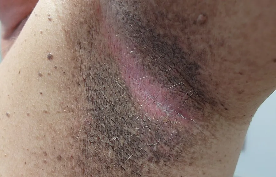 Acanthosis nigricans in the underarm: dark, thickened skin with a velvety texture