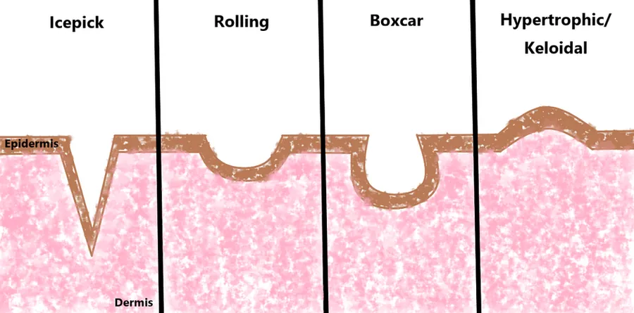 Diagram of a skin cross-section showing ice-pick, rolling, boxcar and hypertrophic acne scars