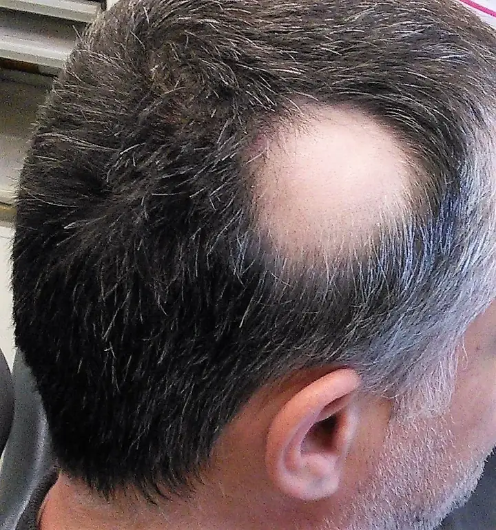 A smooth, round bald patch on the scalp from alopecia areata