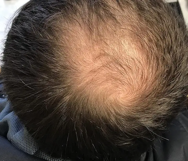 Thinning hair at the crown in a man with male pattern hair loss