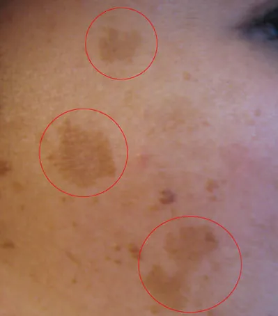 Brown melasma patches on the cheek, circled in red
