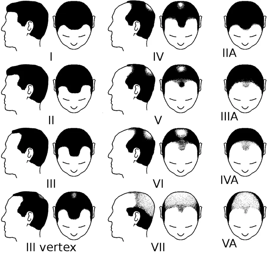 Norwood scale drawing showing the stages of male pattern hair loss