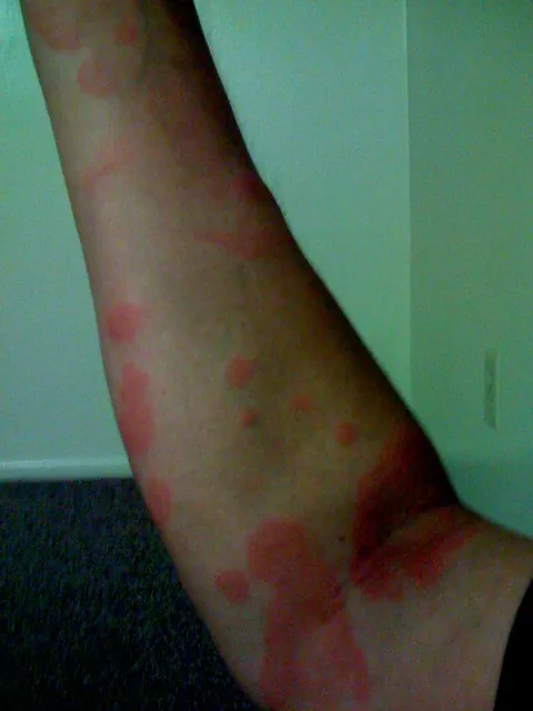 Raised red hive welts on the arm